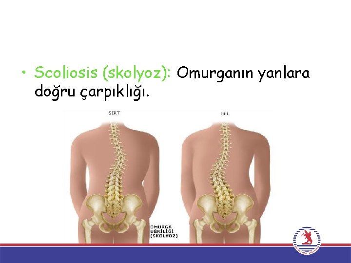  • Scoliosis (skolyoz): Omurganın yanlara doğru çarpıklığı. 