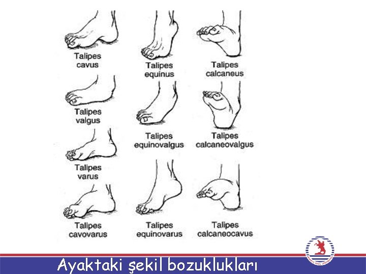 Ayaktaki şekil bozuklukları 