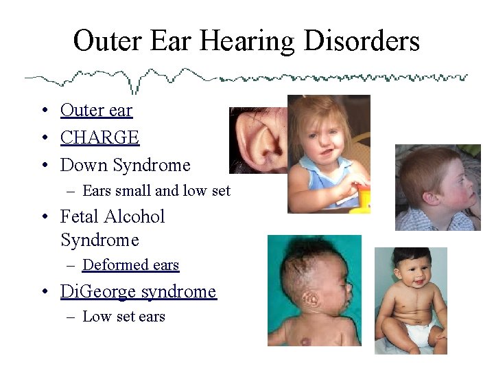 Outer Ear Hearing Disorders • Outer ear • CHARGE • Down Syndrome – Ears