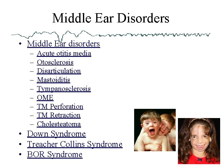 Middle Ear Disorders • Middle Ear disorders – – – – – Acute otitis