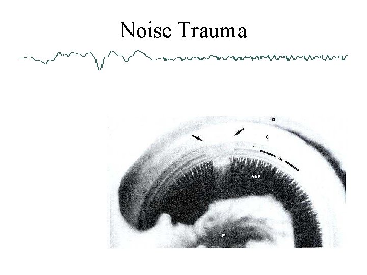 Noise Trauma 