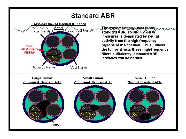 Standard ABR Cross-section of Internal Auditory Canal Sup. Vest Nerve Facial Nerve HIGHFREQUENCY FIBERS