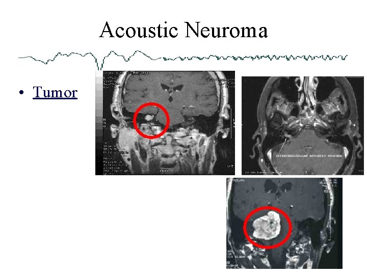 Acoustic Neuroma • Tumor 