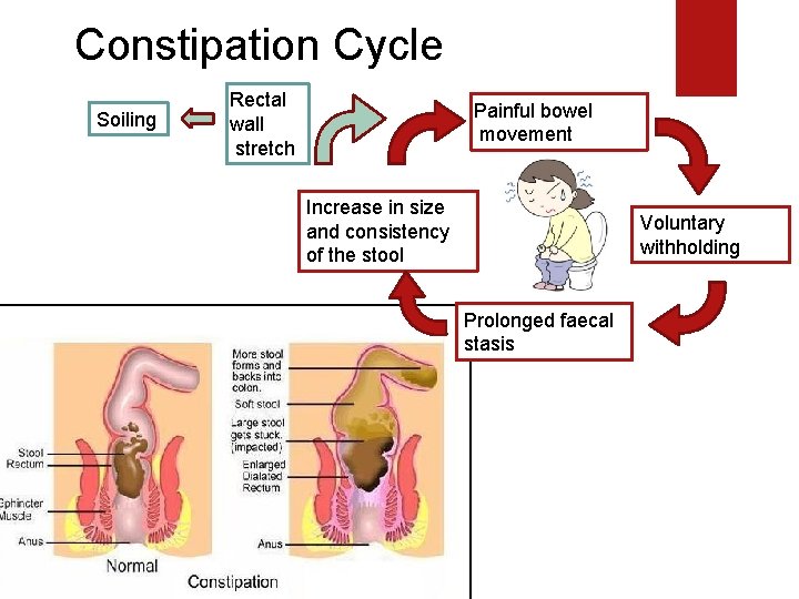 Constipation Cycle Soiling Rectal wall stretch Painful bowel movement Increase in size and consistency