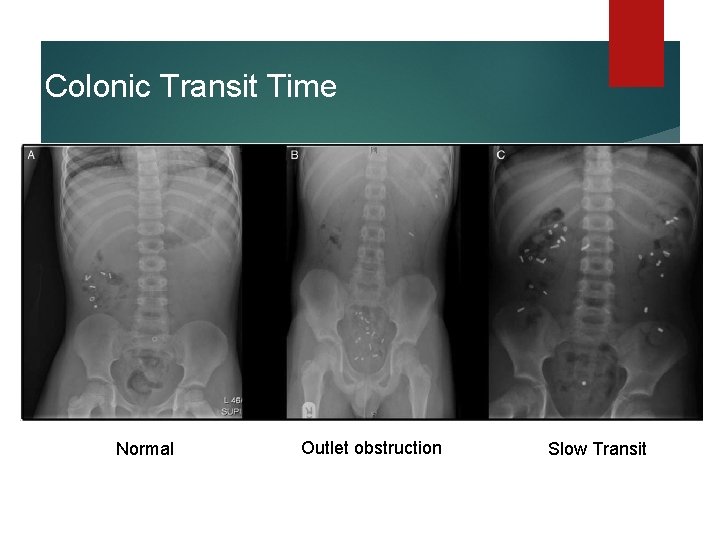 Colonic Transit Time Normal Outlet obstruction Slow Transit 