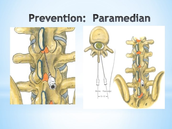 Prevention: Paramedian *Median vs. Paramedian 