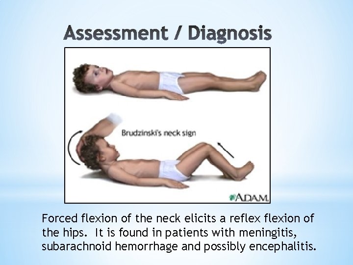 Assessment / Diagnosis Forced flexion of the neck elicits a reflexion of the hips.