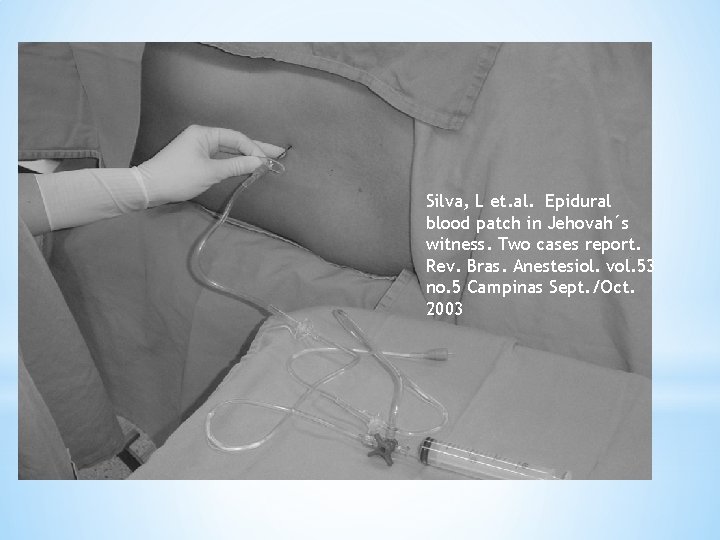 Silva, L et. al. Epidural blood patch in Jehovah´s witness. Two cases report. Rev.