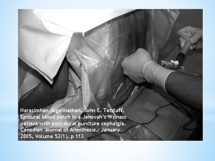 Narasimhan Jagannathan, John E. Tetzlaff. Epidural blood patch in a Jehovah’s Witness patient with
