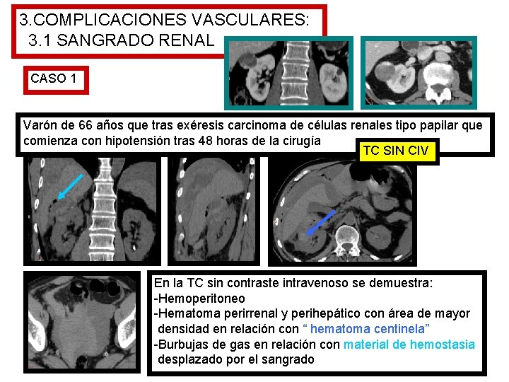 3. COMPLICACIONES VASCULARES: 3. 1 SANGRADO RENAL CASO 1 Varón de 66 años que