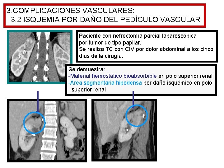 3. COMPLICACIONES VASCULARES: 3. 2 ISQUEMIA POR DAÑO DEL PEDÍCULO VASCULAR Paciente con nefrectomía