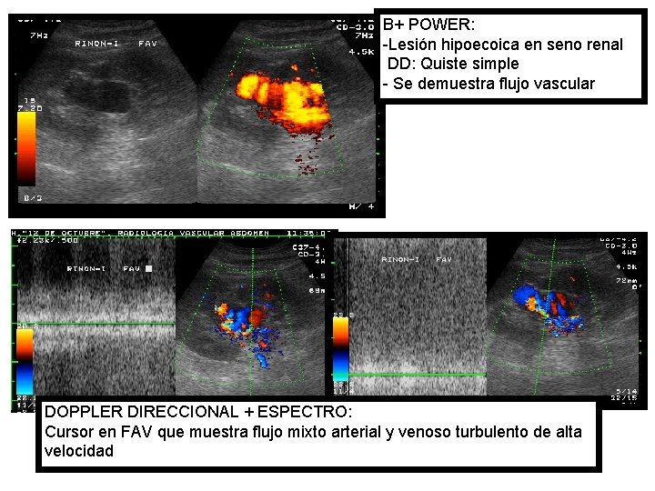 B+ POWER: -Lesión hipoecoica en seno renal DD: Quiste simple - Se demuestra flujo