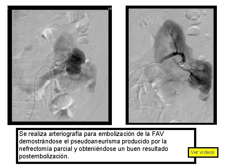 Se realiza arteriografía para embolización de la FAV demostrándose el pseudoaneurisma producido por la
