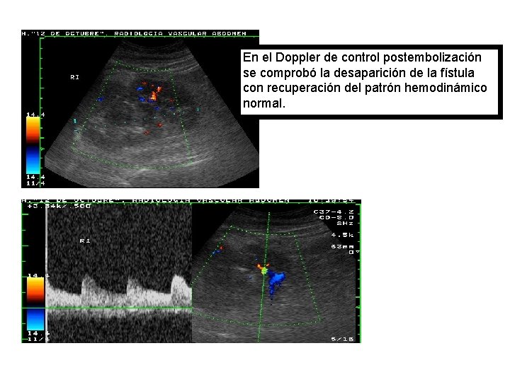 En el Doppler de control postembolización se comprobó la desaparición de la fístula con