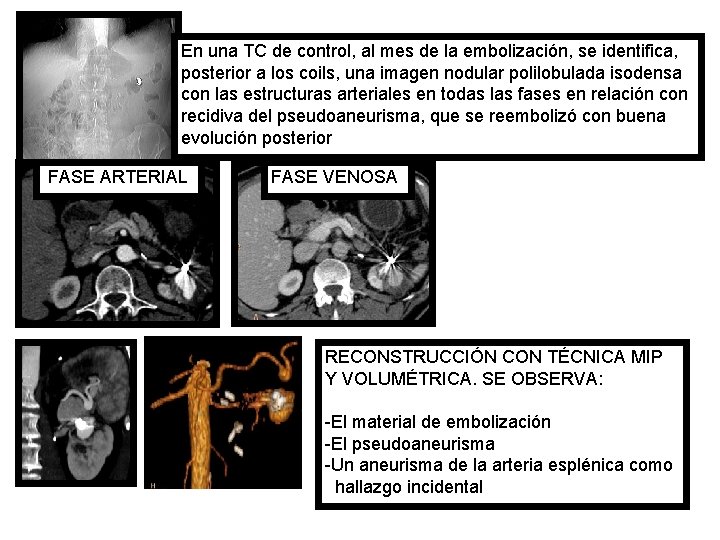 En una TC de control, al mes de la embolización, se identifica, posterior a