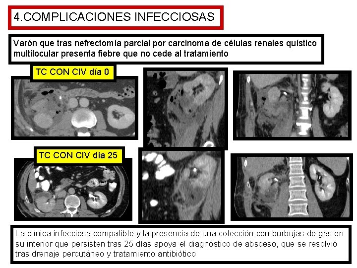 4. COMPLICACIONES INFECCIOSAS Varón que tras nefrectomía parcial por carcinoma de células renales quístico