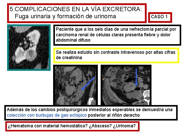 5. COMPLICACIONES EN LA VÍA EXCRETORA: Fuga urinaria y formación de urinoma CASO 1