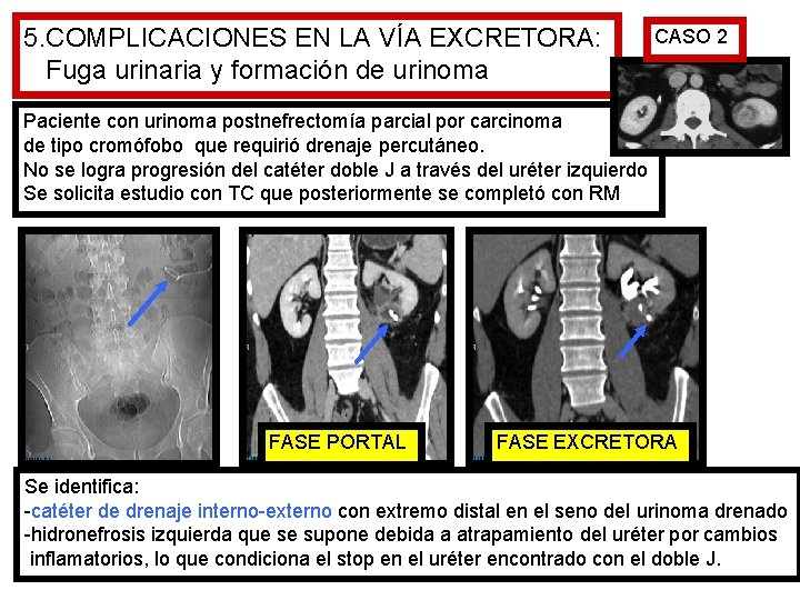 5. COMPLICACIONES EN LA VÍA EXCRETORA: Fuga urinaria y formación de urinoma CASO 2