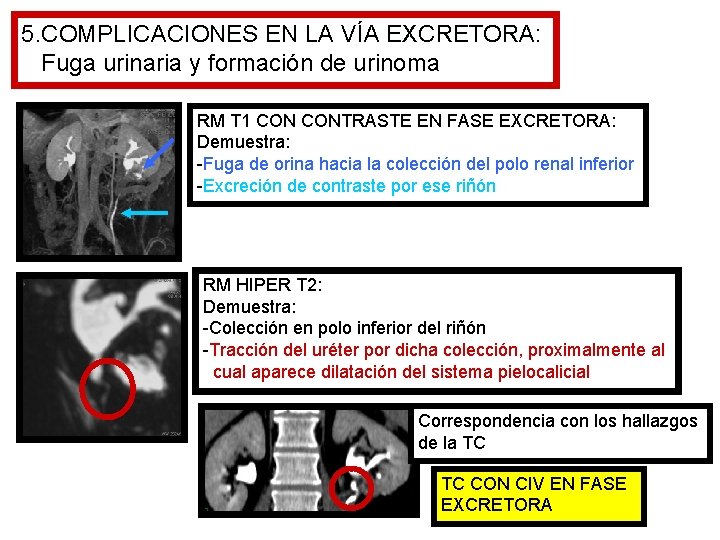 5. COMPLICACIONES EN LA VÍA EXCRETORA: Fuga urinaria y formación de urinoma RM T