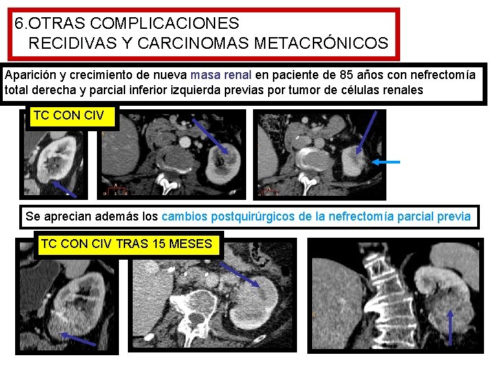 6. OTRAS COMPLICACIONES RECIDIVAS Y CARCINOMAS METACRÓNICOS Aparición y crecimiento de nueva masa renal