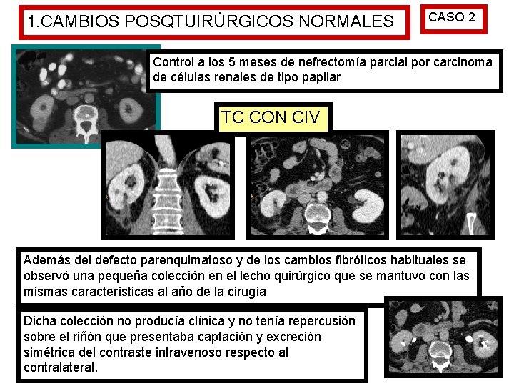 1. CAMBIOS POSQTUIRÚRGICOS NORMALES CASO 2 Control a los 5 meses de nefrectomía parcial