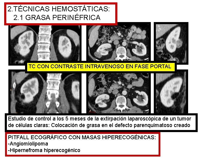 2. TÉCNICAS HEMOSTÁTICAS: 2. 1 GRASA PERINÉFRICA TC CONTRASTE INTRAVENOSO EN FASE PORTAL Estudio