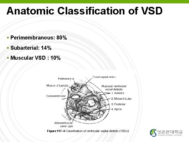 Anatomic Classification of VSD Perimembranous: 80% Subarterial: 14% Muscular VSD : 10% Figure 117–