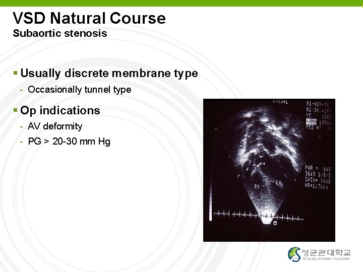 VSD Natural Course Subaortic stenosis Usually discrete membrane type - Occasionally tunnel type Op