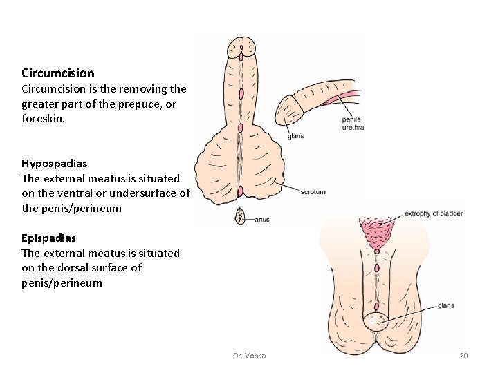 Circumcision is the removing the greater part of the prepuce, or foreskin. Hypospadias The