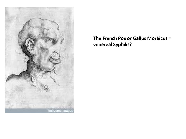 The French Pox or Gallus Morbicus = venereal Syphilis? 