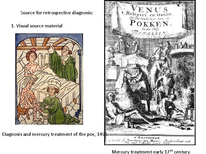 Source for retrospective diagnosis: 1. Visual source material Diagnosis and mercury treatment of the