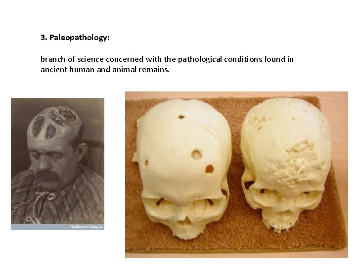 3. Paleopathology: branch of science concerned with the pathological conditions found in ancient human