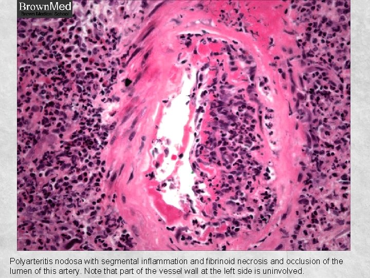 Polyarteritis nodosa with segmental inflammation and fibrinoid necrosis and occlusion of the lumen of