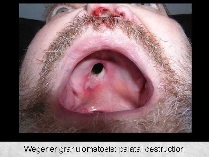 Wegener granulomatosis: palatal destruction 