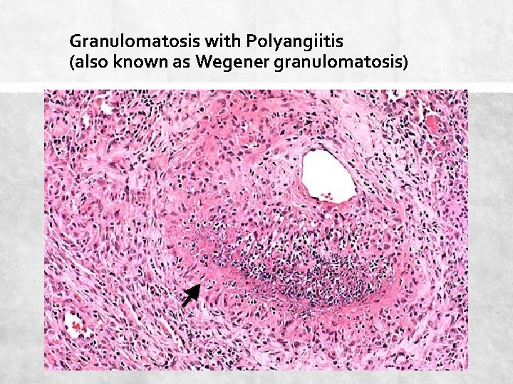 Granulomatosis with Polyangiitis (also known as Wegener granulomatosis) 