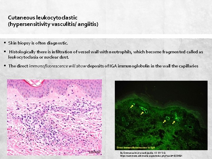 Cutaneous leukocytoclastic (hypersensitivity vasculitis/ angiitis) § Skin biopsy is often diagnostic. § Histologically there