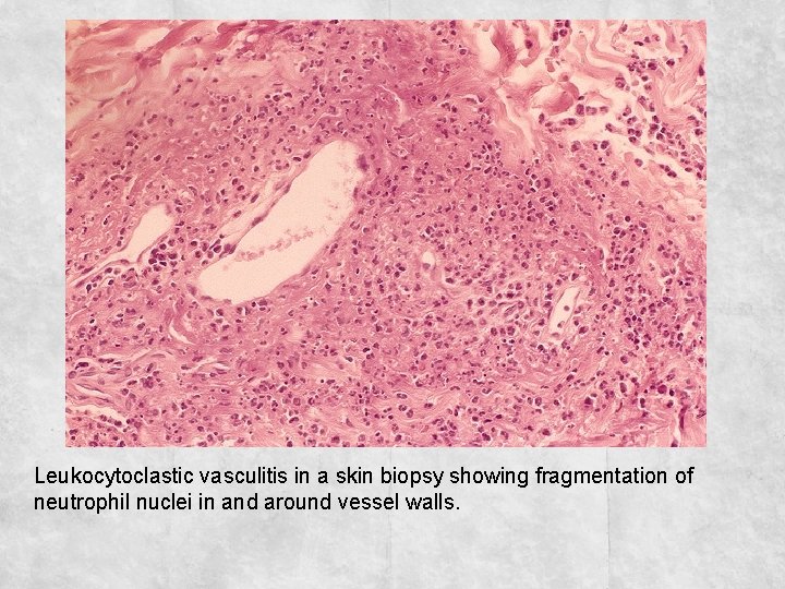 Leukocytoclastic vasculitis in a skin biopsy showing fragmentation of neutrophil nuclei in and around