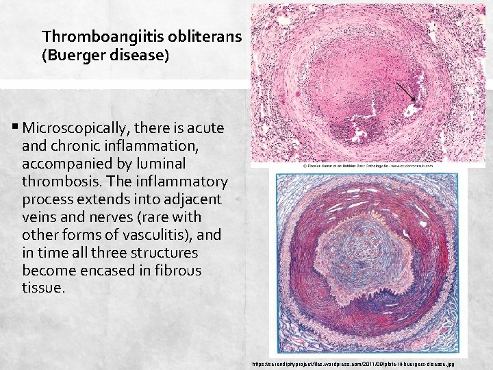 Thromboangiitis obliterans (Buerger disease) § Microscopically, there is acute and chronic inflammation, accompanied by