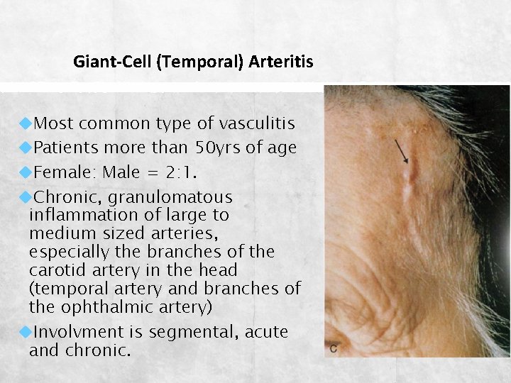 Giant-Cell (Temporal) Arteritis Most common type of vasculitis Patients more than 50 yrs of