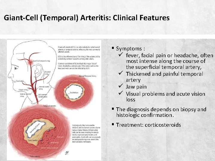 Giant-Cell (Temporal) Arteritis: Clinical Features § Symptoms : ü fever, facial pain or headache,