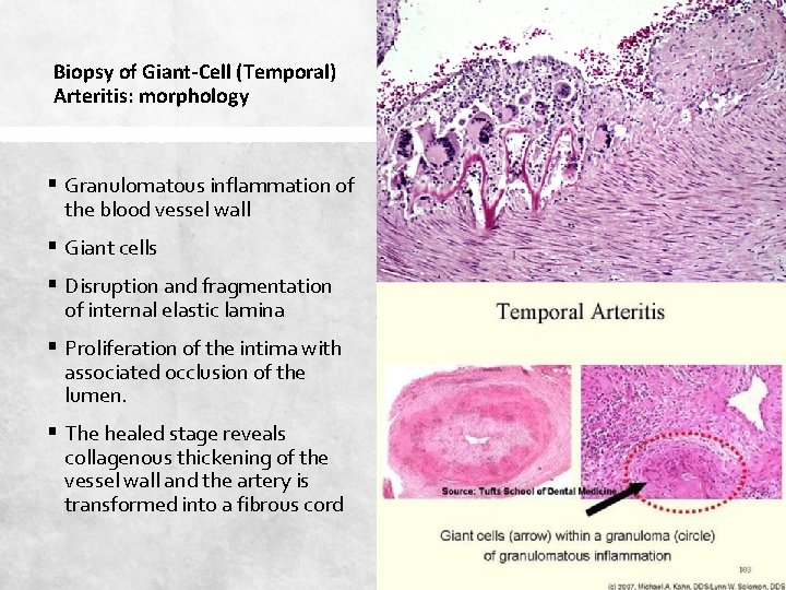 Biopsy of Giant-Cell (Temporal) Arteritis: morphology § Granulomatous inflammation of the blood vessel wall