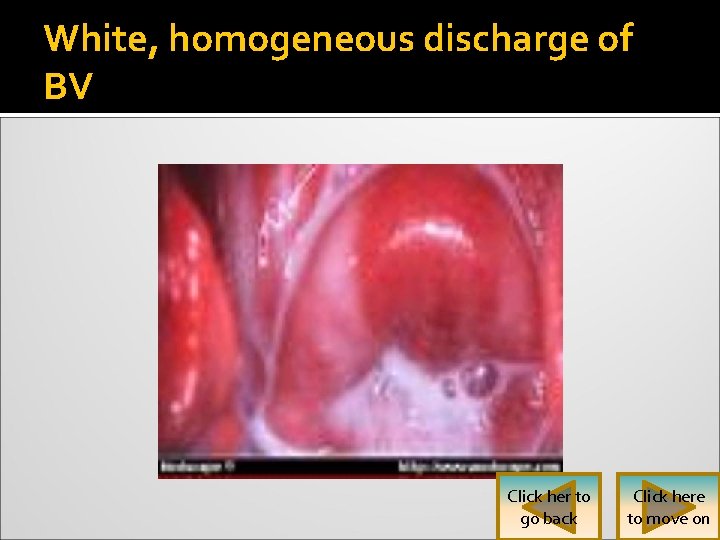 White, homogeneous discharge of BV Click her to go back Click here to move