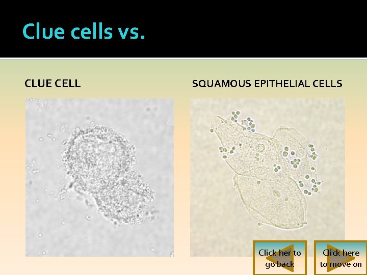 Clue cells vs. CLUE CELL SQUAMOUS EPITHELIAL CELLS Click her to go back Click