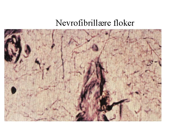 Nevrofibrillære floker 