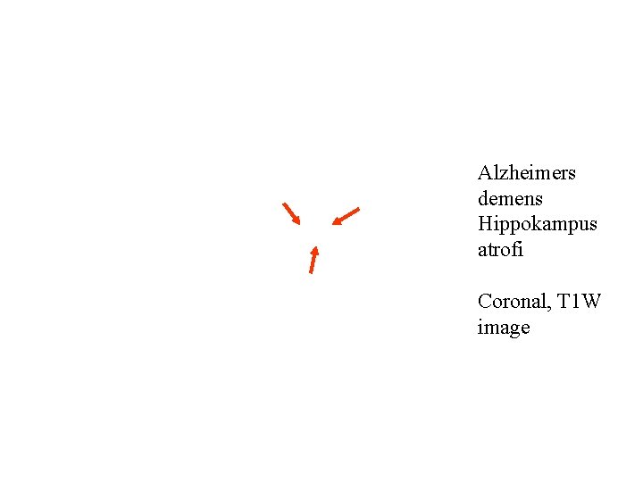 Alzheimers demens Hippokampus atrofi Coronal, T 1 W image 