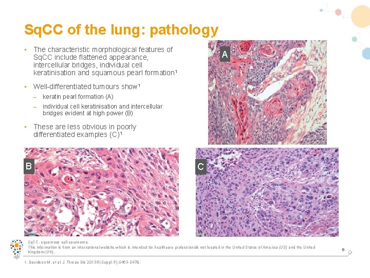 Sq. CC of the lung: pathology • The characteristic morphological features of Sq. CC