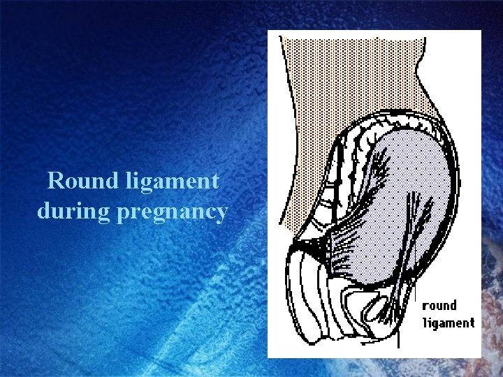 Round ligament during pregnancy Round ligament during pregnancy