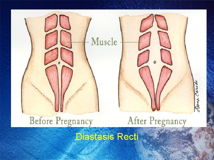 Diastasis Recti Diastasis Recti
