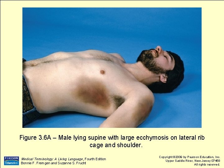 Figure 3. 6 A – Male lying supine with large ecchymosis on lateral rib