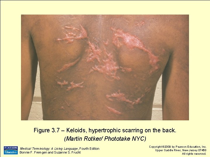 Figure 3. 7 – Keloids, hypertrophic scarring on the back. (Martin Rotker/ Phototake NYC)